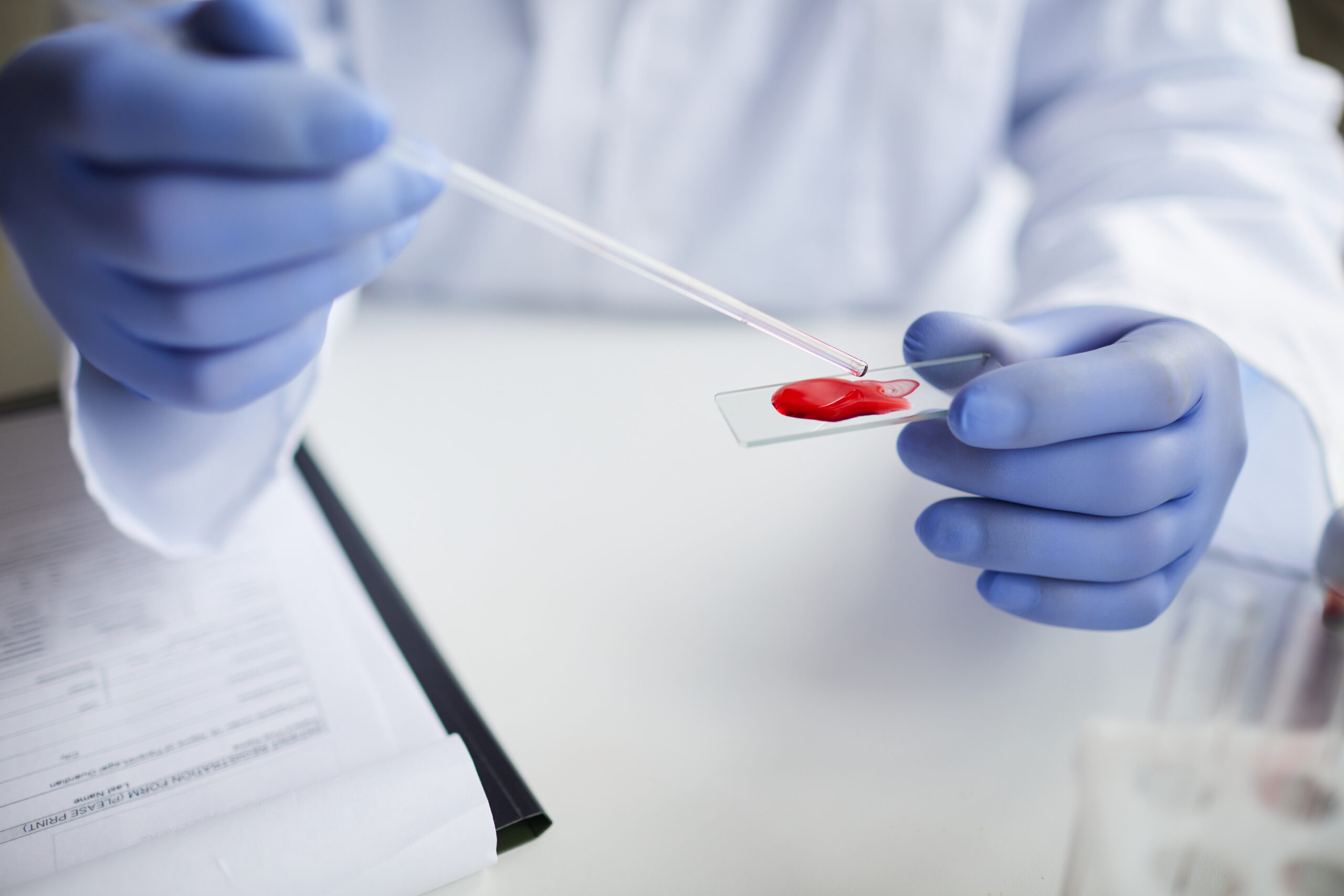 Close-up of gloved hands placing a blood sample on a microscope slide.