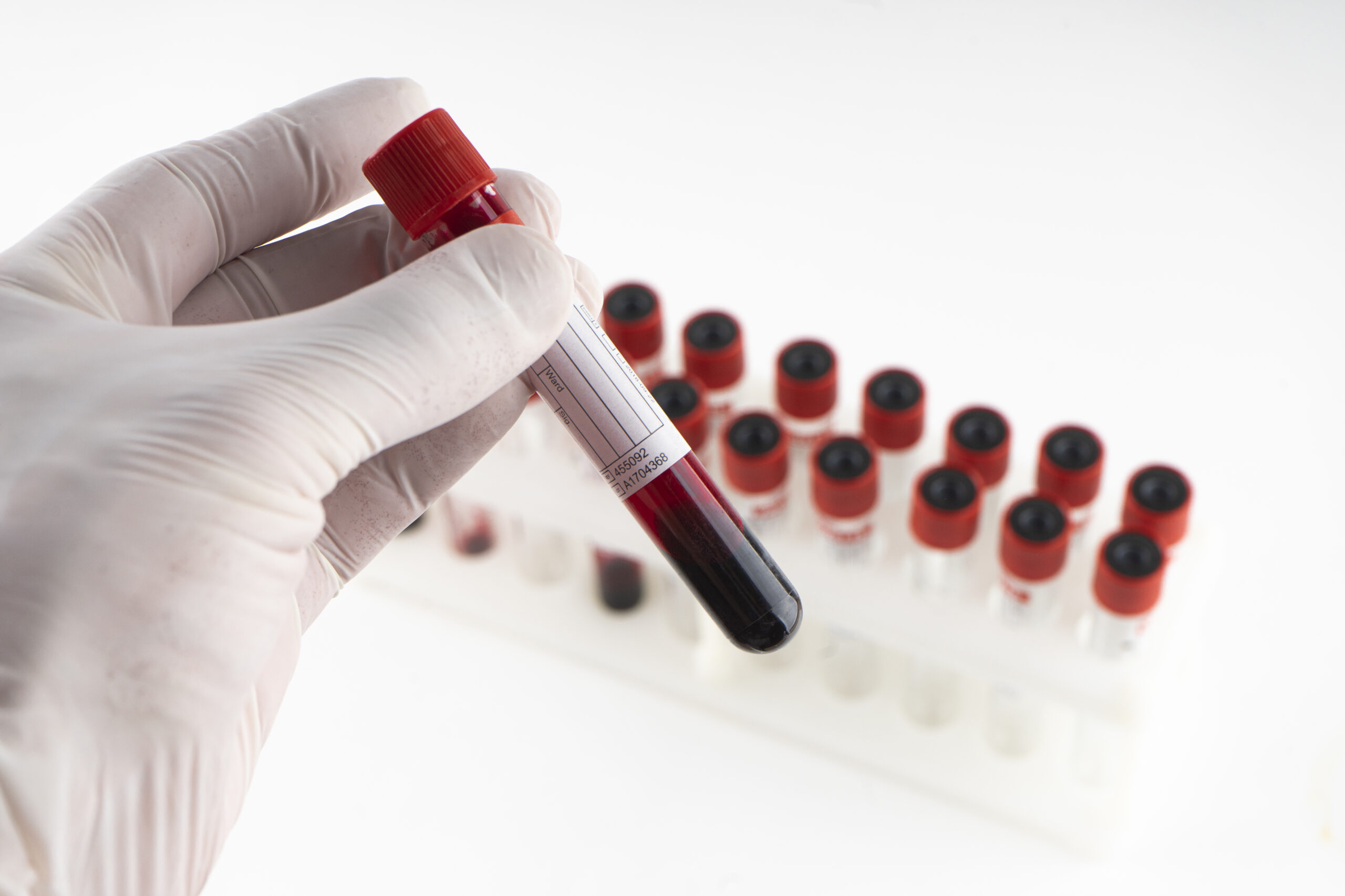 Gloved hand holding blood sample tube; ID: 4655092, A1704368