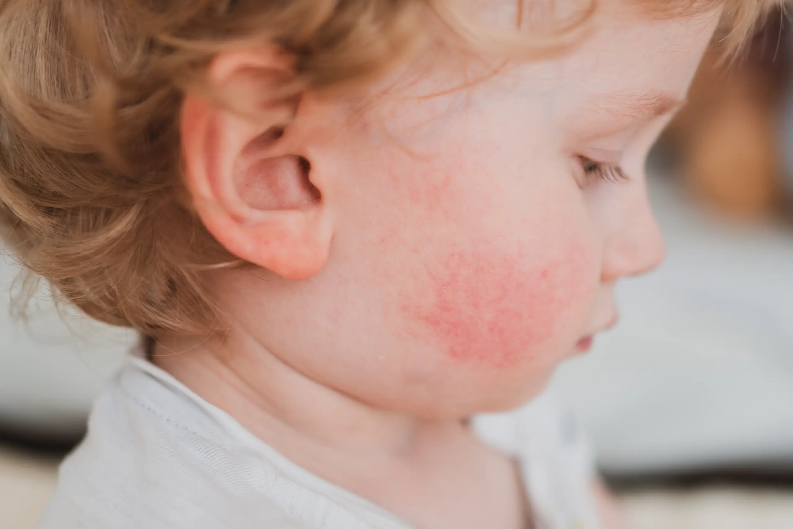 Close-up of toddler's cheek with red, inflamed eczema rash.