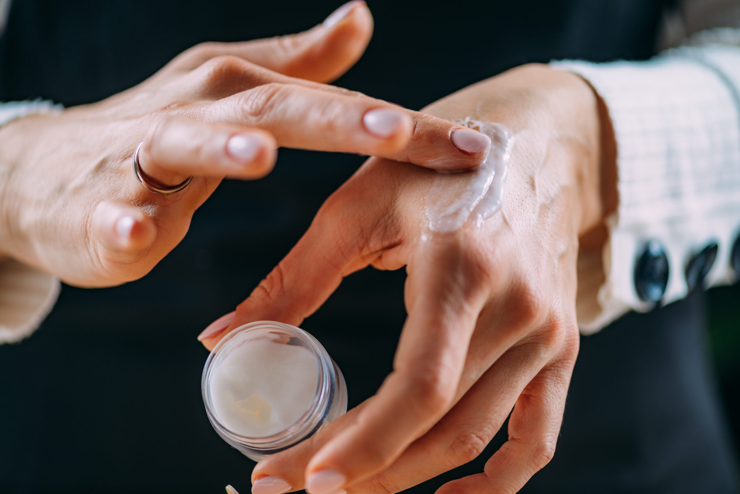 Applying cream to hand for eczema relief