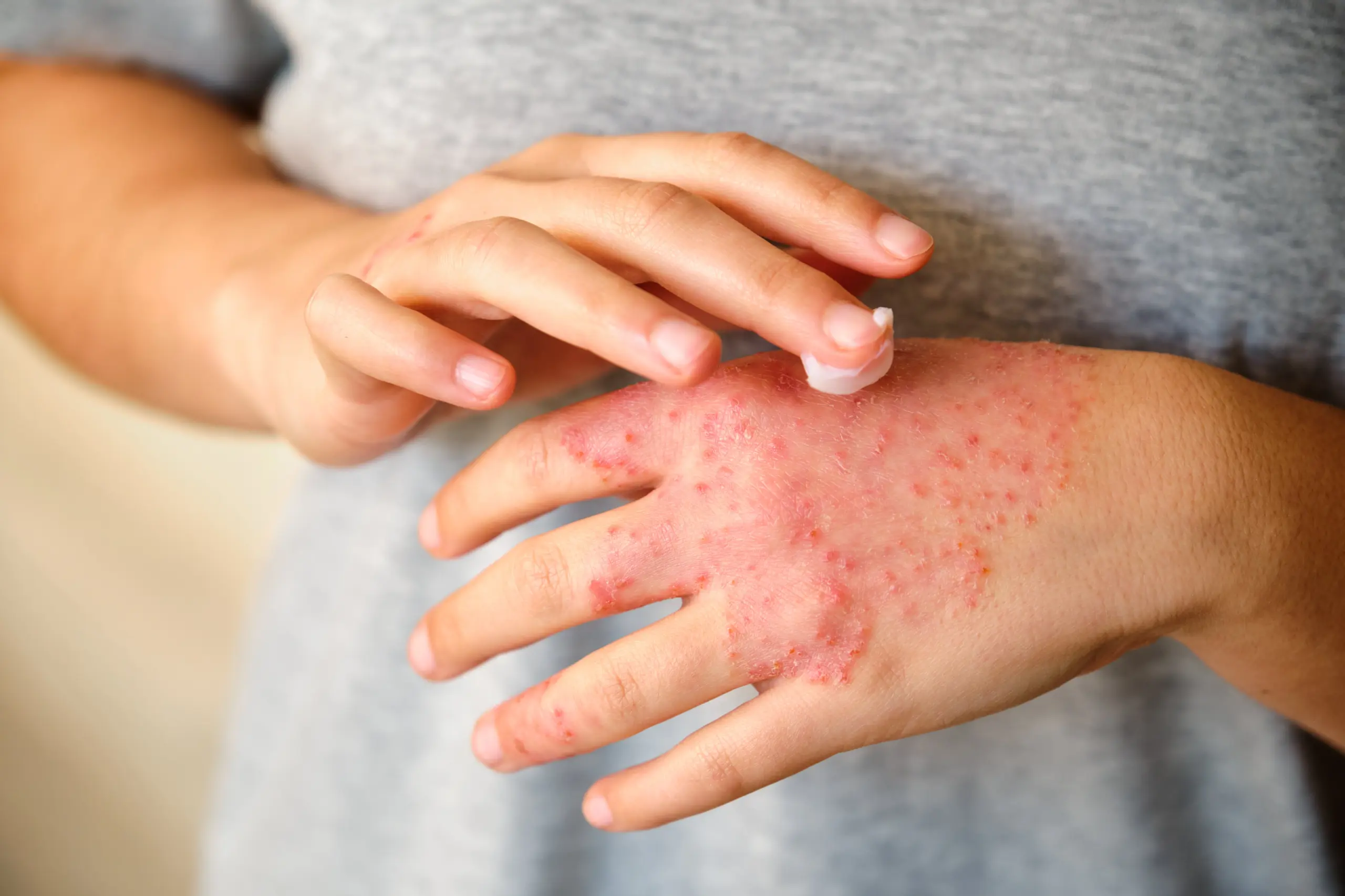 Close-up of a hand with eczema, applying cream. Eczema test.